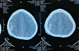 颅脑外伤致癫痫患者一例