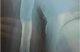 我院创伤骨科对一例“右肱骨干粉碎性骨折闭合复位髓内钉内固定术”患者的手术及跟踪