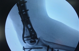 我院创伤骨科成功完成“肱骨髁间粉碎性骨折”手术